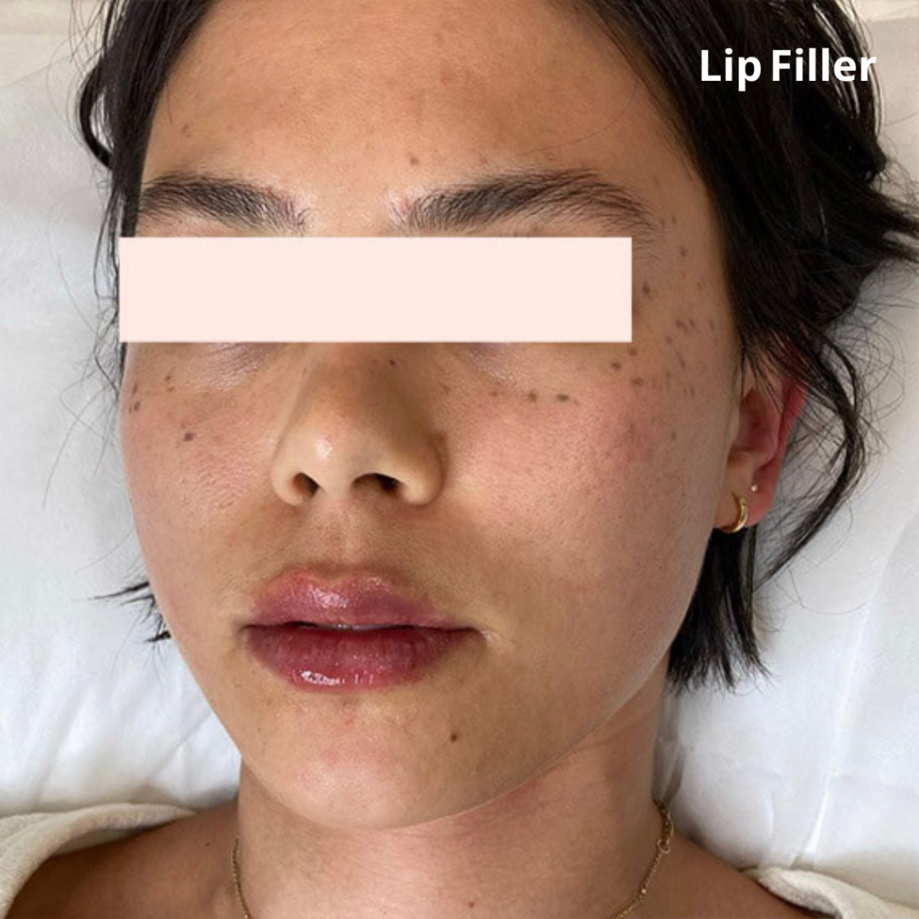 After TEOSYAL️® Lip Dermal Filler